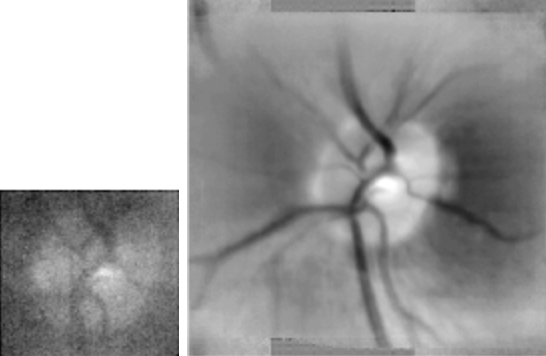 Figure 2. Retinal images obtained with a table-top video ophthalmoscope. The left hand panel shows a subsampled version of a single video field, in which a faint image of the optic disk and retinal blood vessels may be seen on a large background of camera noise. The right hand panel shows a composite image constructed by registering and averaging approximately 1000 images such as that shown in the left panel.